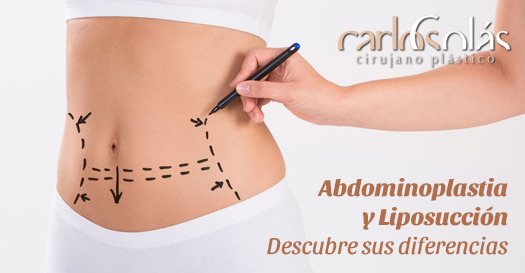 ▷ Cirugia de Abdomen【Lipoescultura, Abdominoplastia, Liposucción】